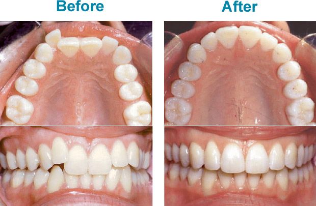 Previs site alleen achter Invisalign®: voor en na | Tandheelkundig Centrum Nootdorp