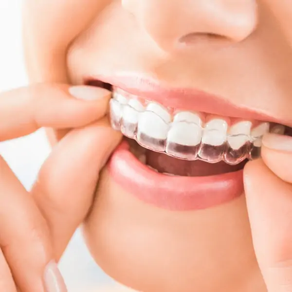 Vrouw doet invisalign onzichtbare beugel in